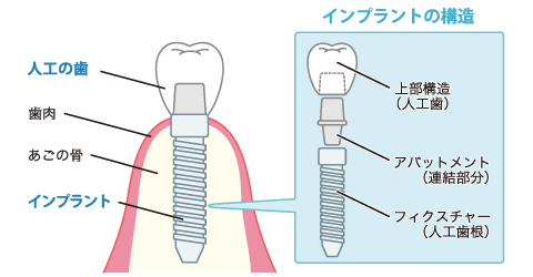 インプラントの構造